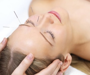 Akupunktura Akupunktura-lice